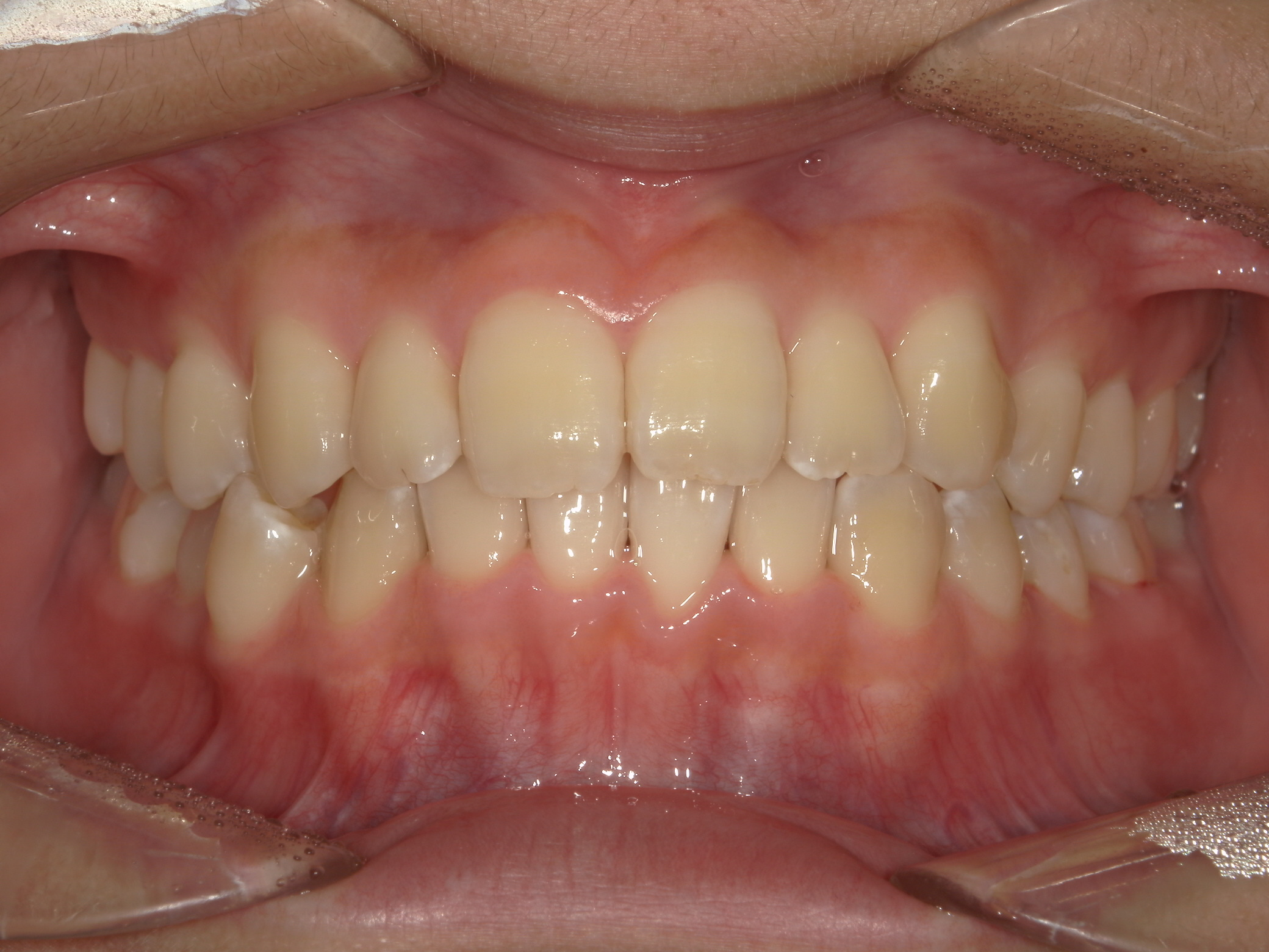 交差咬合 アフター