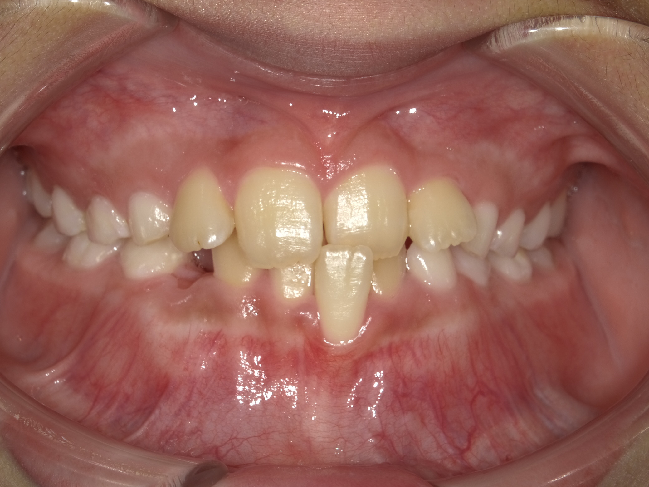 交差咬合 ビフォー