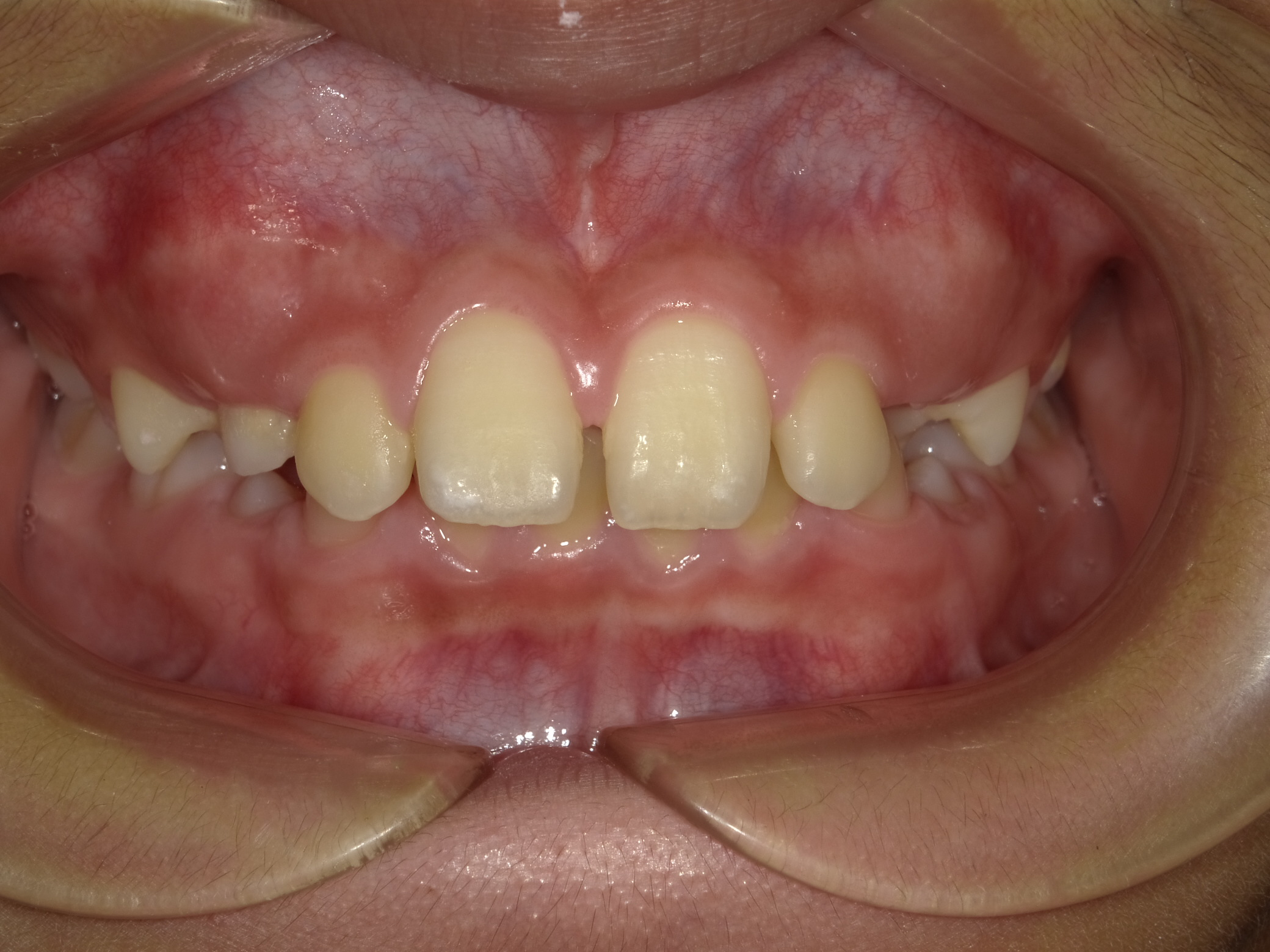 上顎前突 ビフォー