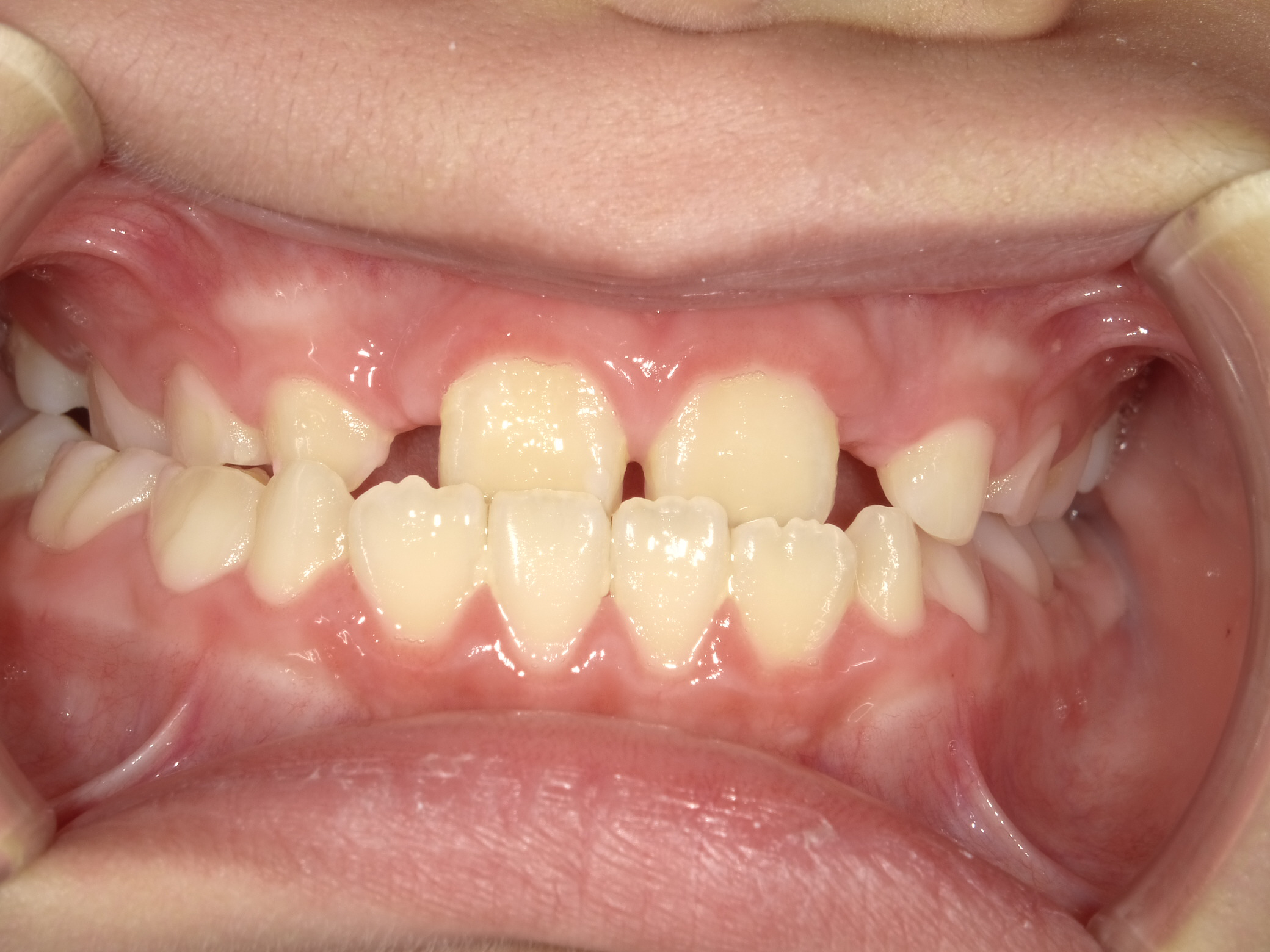 反対咬合 ビフォー