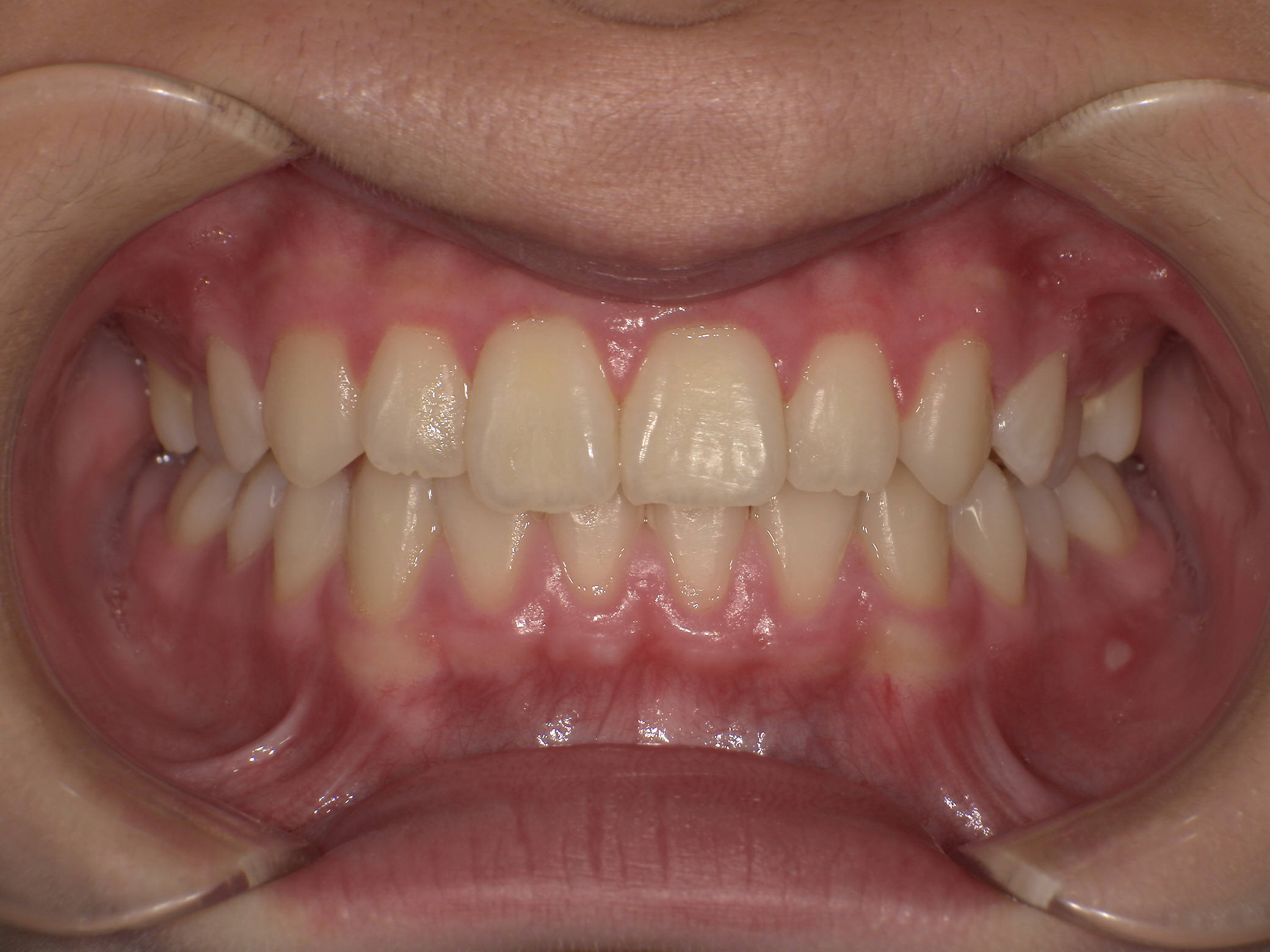 反対咬合 アフター