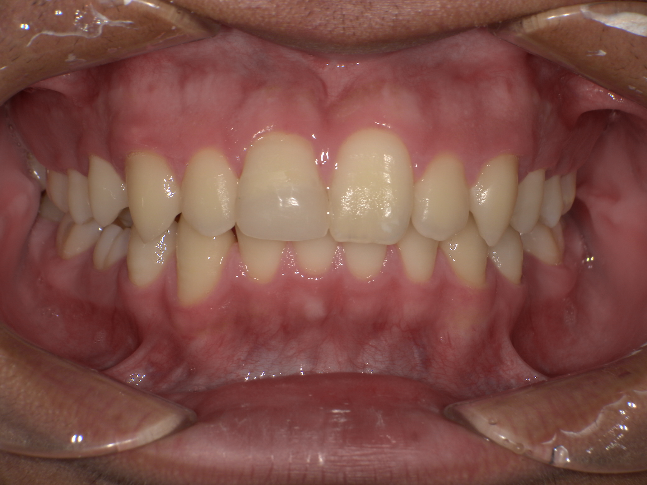 上顎前突 アフター